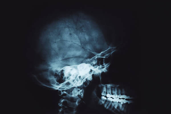 Остеопат при остеохондрозе шейного отдела позвоночника